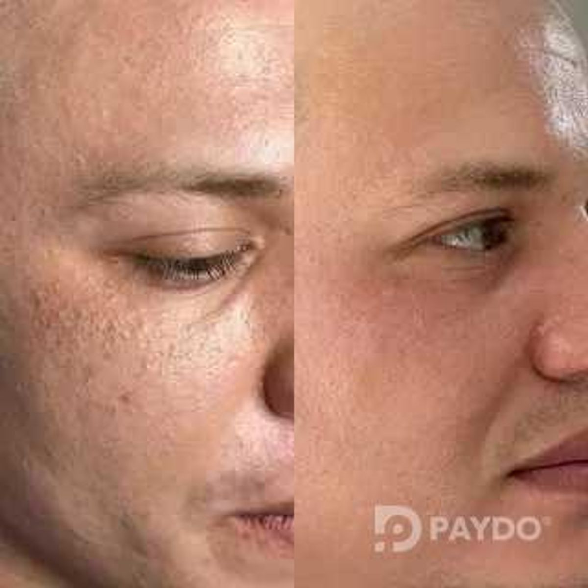Чистка лица от черных точек